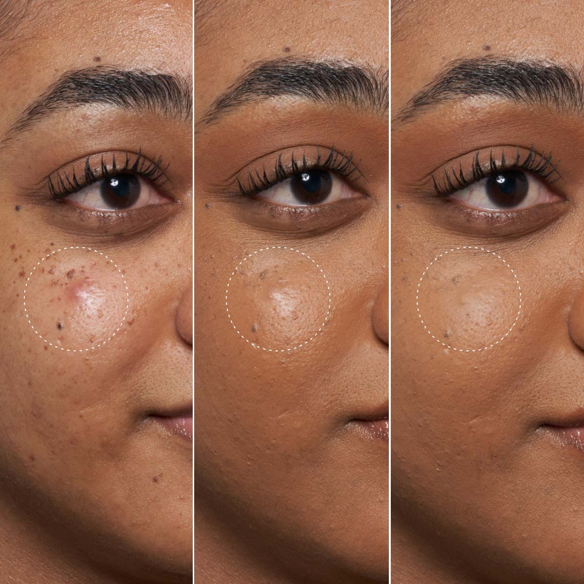BLEMISH DEFEAT'R BHA SPOT TARGETING GEL (GEL FACIAL CON ÁCIDO SALICÍLICO)